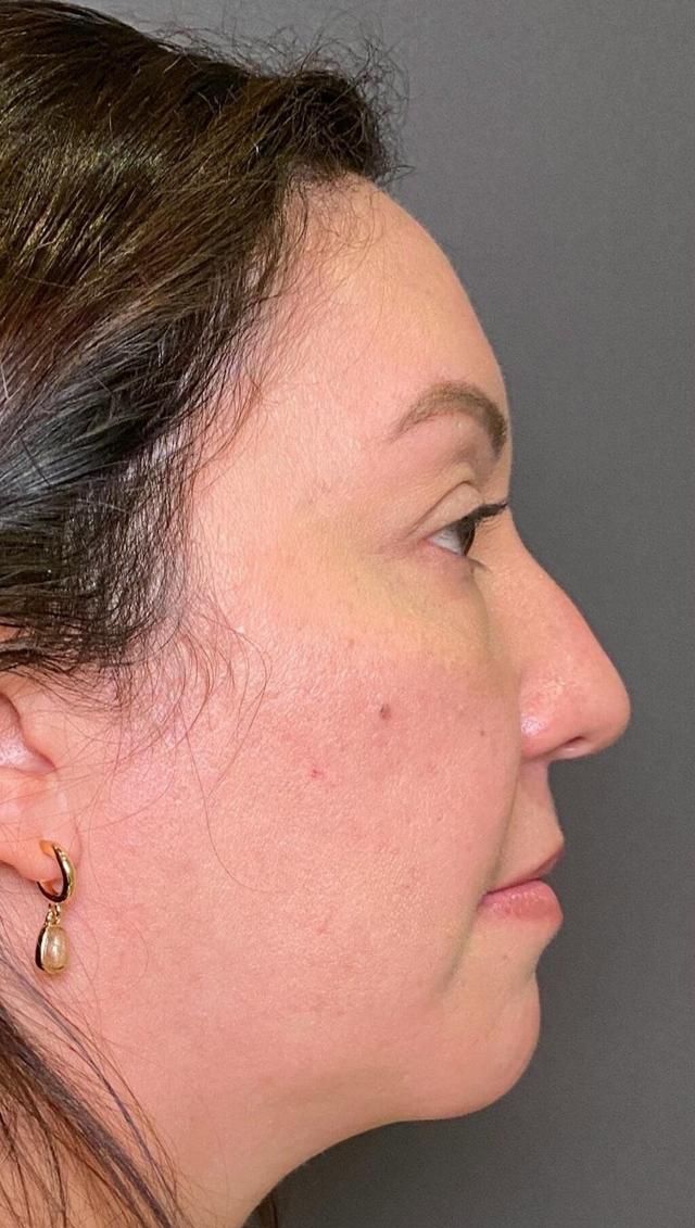 Liquid Rhinoplasty before at Mark G. Albert, MD, FACS in New York, NY
