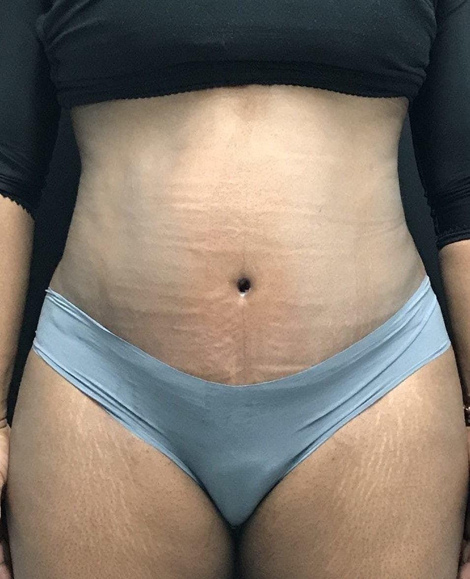 Mark G. Albert, MD, FACS tummy tuck after — New York, NY