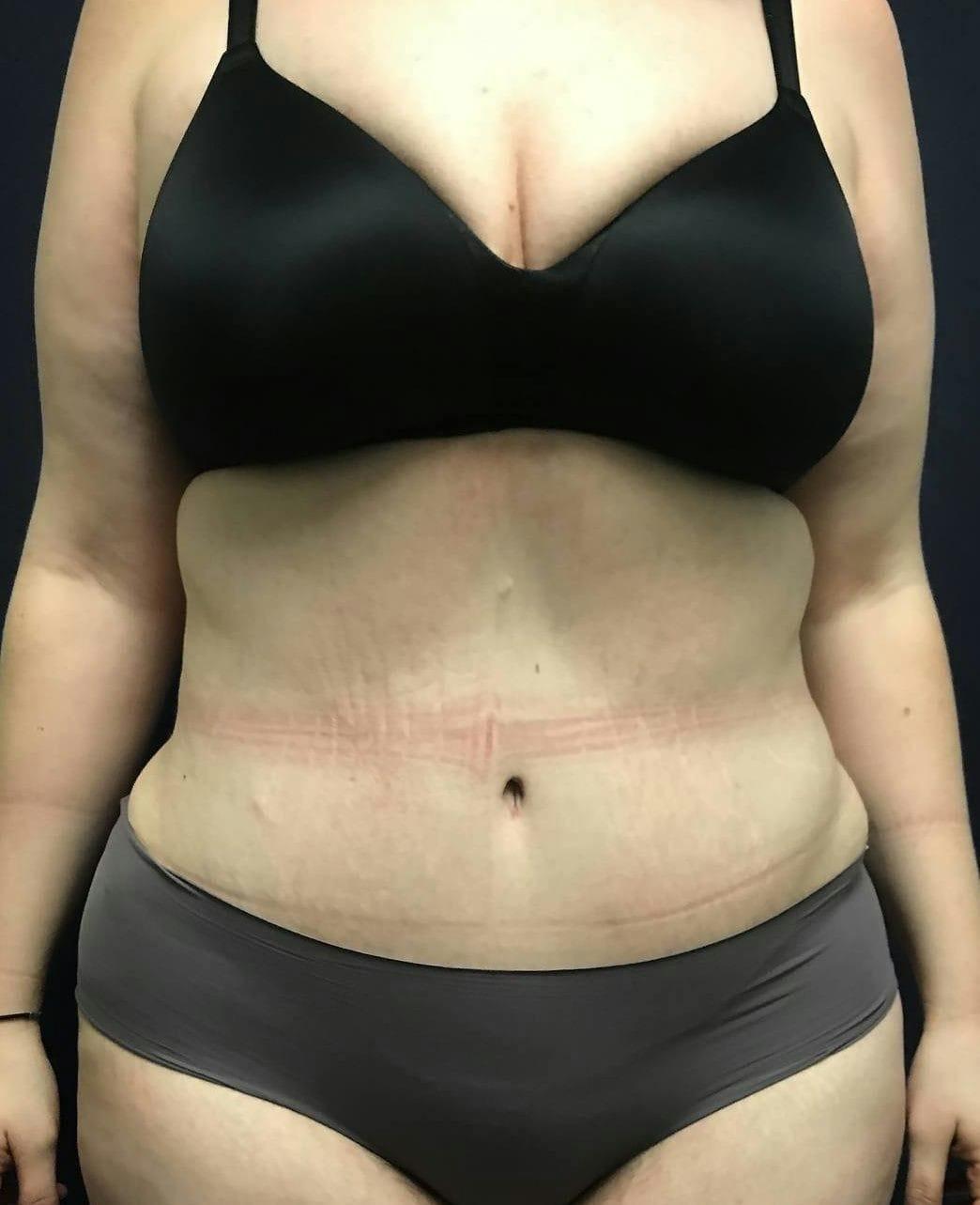 Mark G. Albert, MD, FACS tummy tuck after — New York, NY