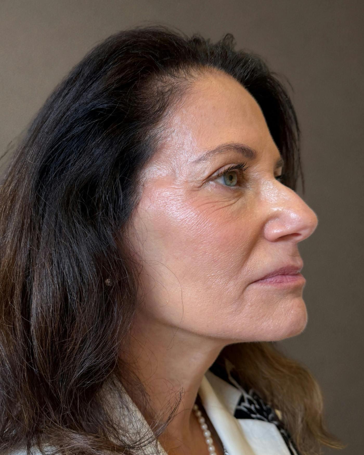 Mark G. Albert, MD, FACS facelift after — New York, NY
