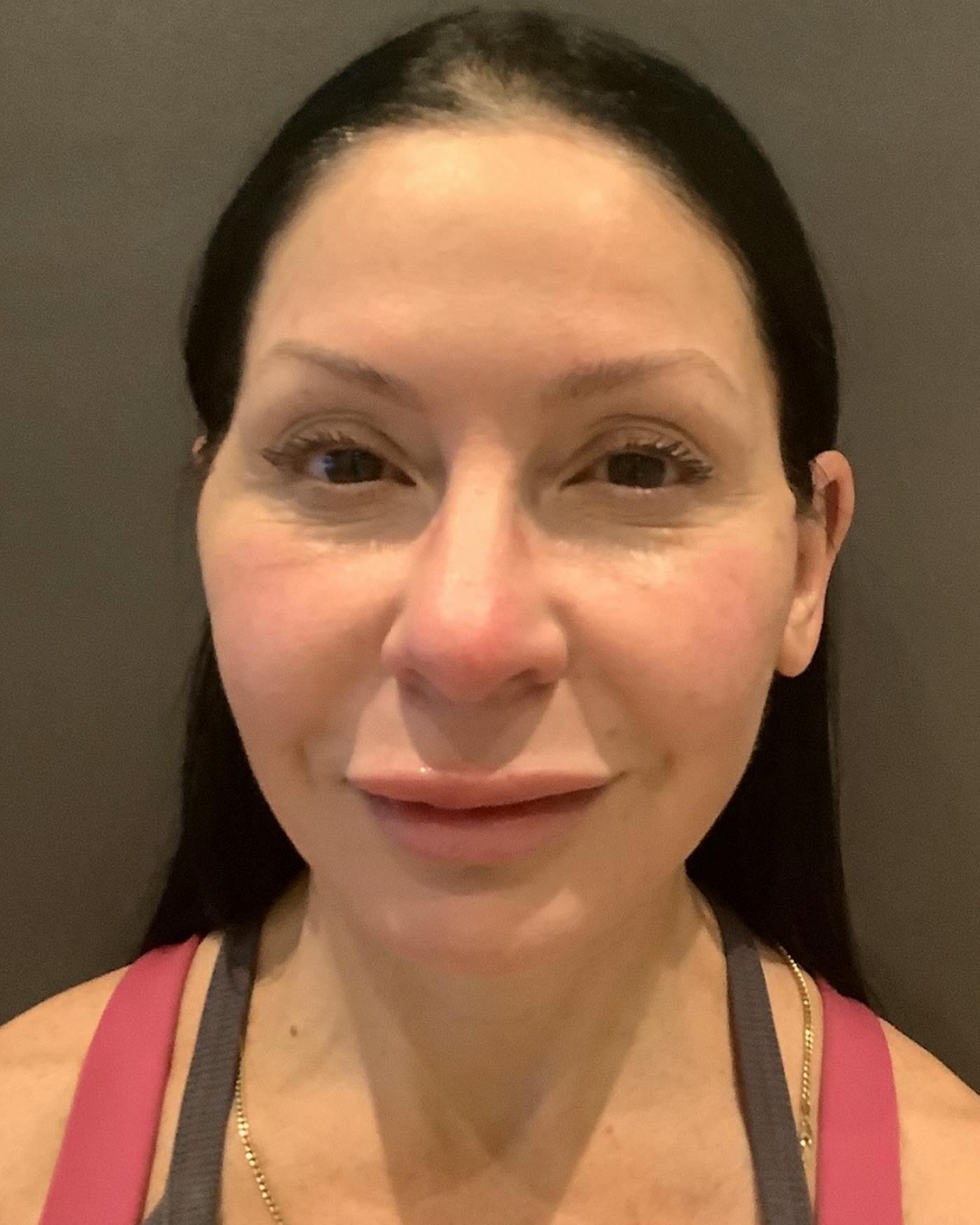 Mark G. Albert, MD, FACS facelift after — New York, NY