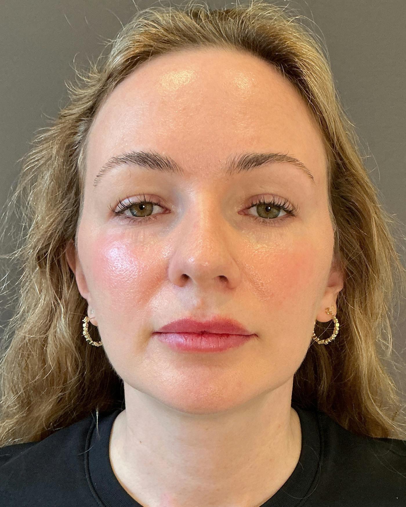 Mark G. Albert, MD, FACS facelift after — New York, NY