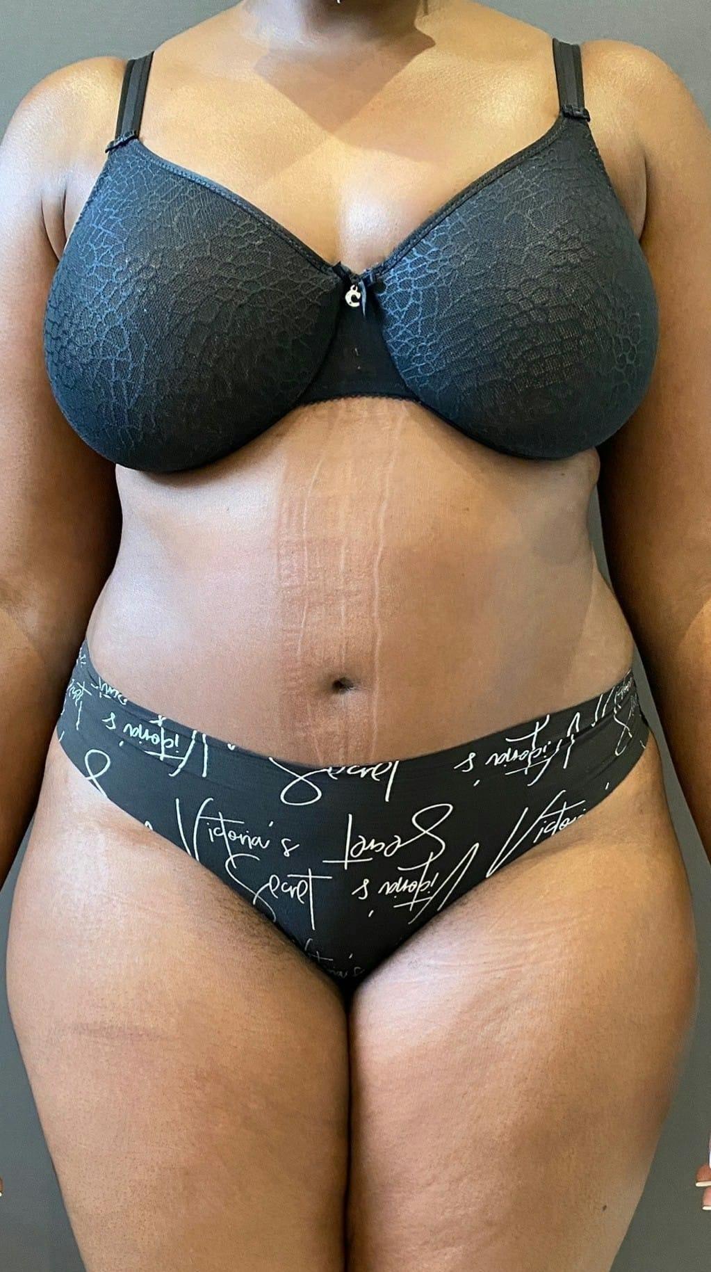 Mark G. Albert, MD, FACS tummy tuck after — New York, NY
