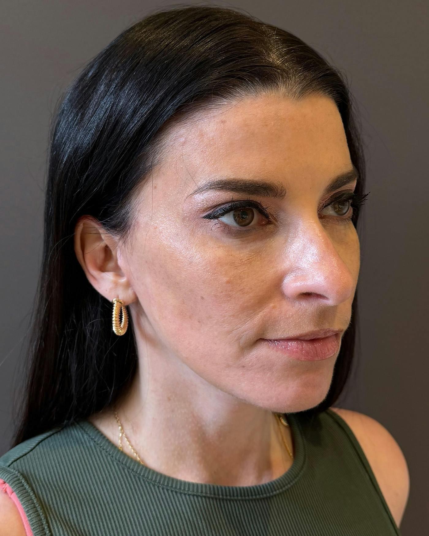Mark G. Albert, MD, FACS facelift after — New York, NY