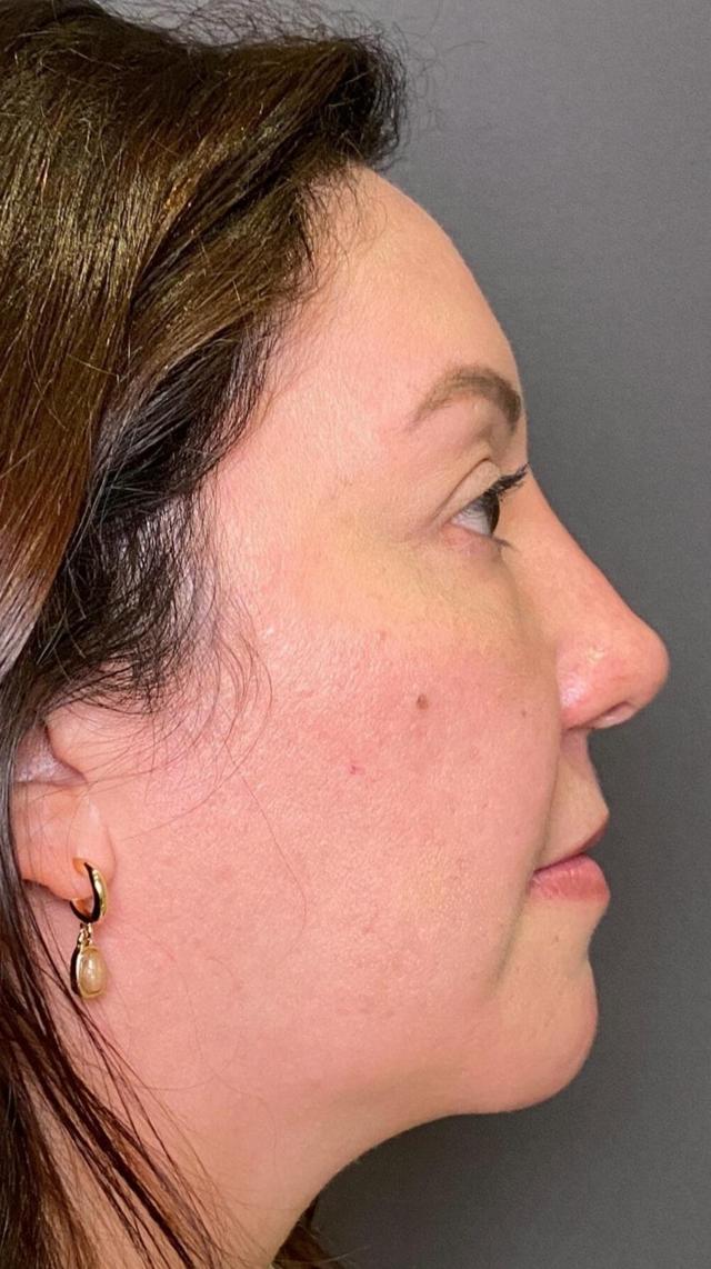 Liquid Rhinoplasty after at Mark G. Albert, MD, FACS in New York, NY