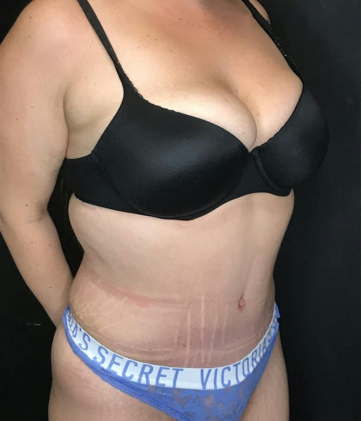 Mark G. Albert, MD, FACS tummy tuck after — New York, NY