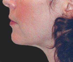 740 Park Plastic Surgery (Stafford R. Broumand, MD) neck liposuction after — New York, NY