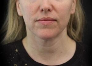 740 Park Plastic Surgery (Stafford R. Broumand, MD) neck liposuction after — New York, NY