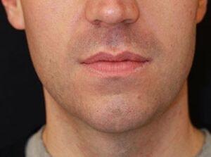 740 Park Plastic Surgery (Stafford R. Broumand, MD) neck liposuction after — New York, NY