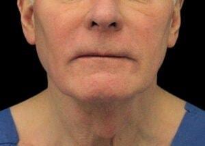 740 Park Plastic Surgery (Stafford R. Broumand, MD) neck liposuction after — New York, NY