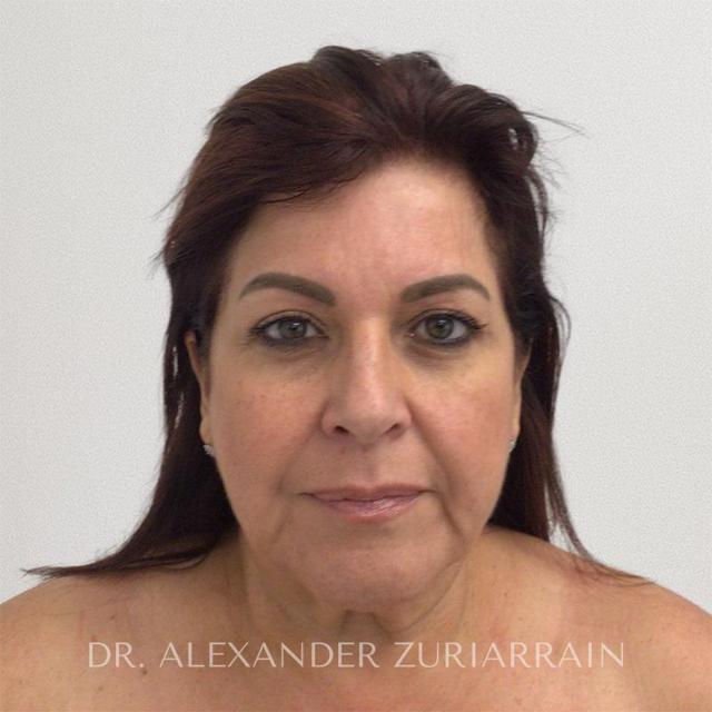 Neck Lift before at Zuri Plastic Surgery - Dr. Zuriarrain in Miami, FL