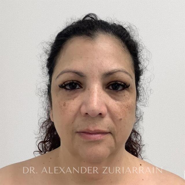 Neck Lift before at Zuri Plastic Surgery - Dr. Zuriarrain in Miami, FL