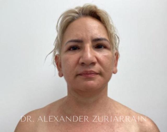 Facelift after at Zuri Plastic Surgery - Dr. Zuriarrain in Miami, FL