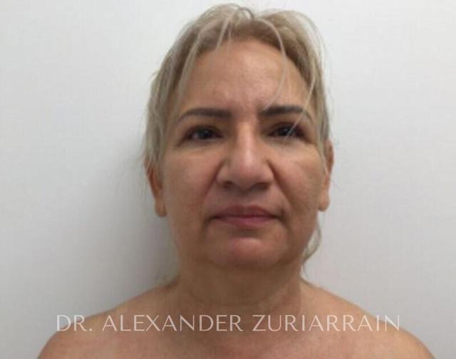 Facelift before at Zuri Plastic Surgery - Dr. Zuriarrain in Miami, FL