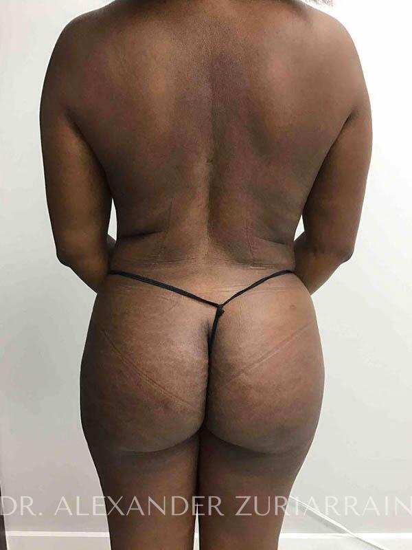 Zuri Plastic Surgery - Dr. Zuriarrain bbl after — Miami, FL