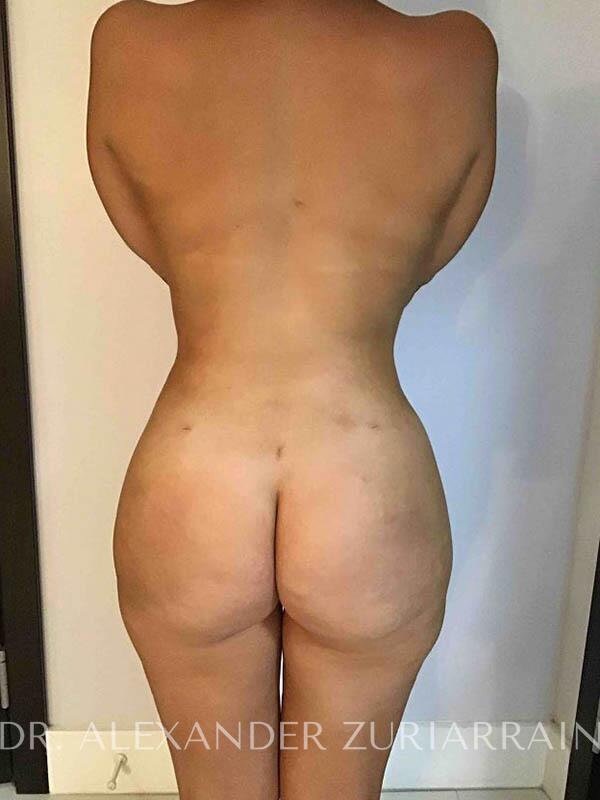 Zuri Plastic Surgery - Dr. Zuriarrain bbl after — Miami, FL