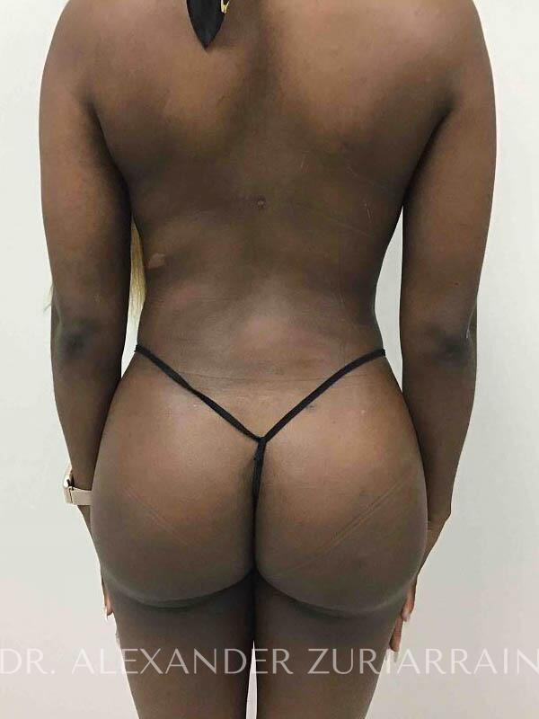 Zuri Plastic Surgery - Dr. Zuriarrain bbl after — Miami, FL