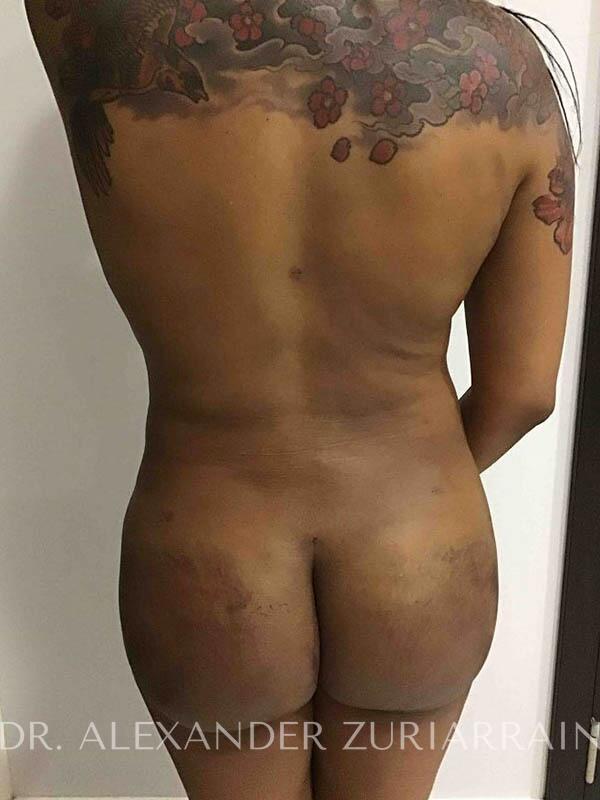 Brazilian Butt Lift after at Zuri Plastic Surgery - Dr. Zuriarrain in Miami, FL
