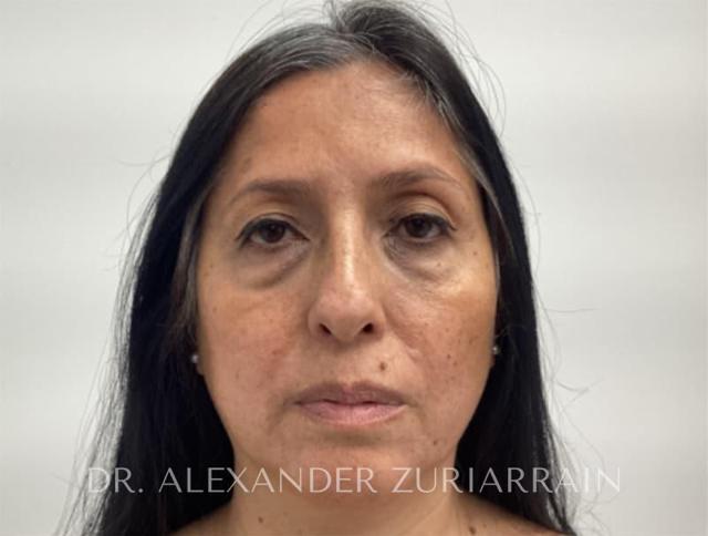 Blepharoplasty before at Zuri Plastic Surgery - Dr. Zuriarrain in Miami, FL