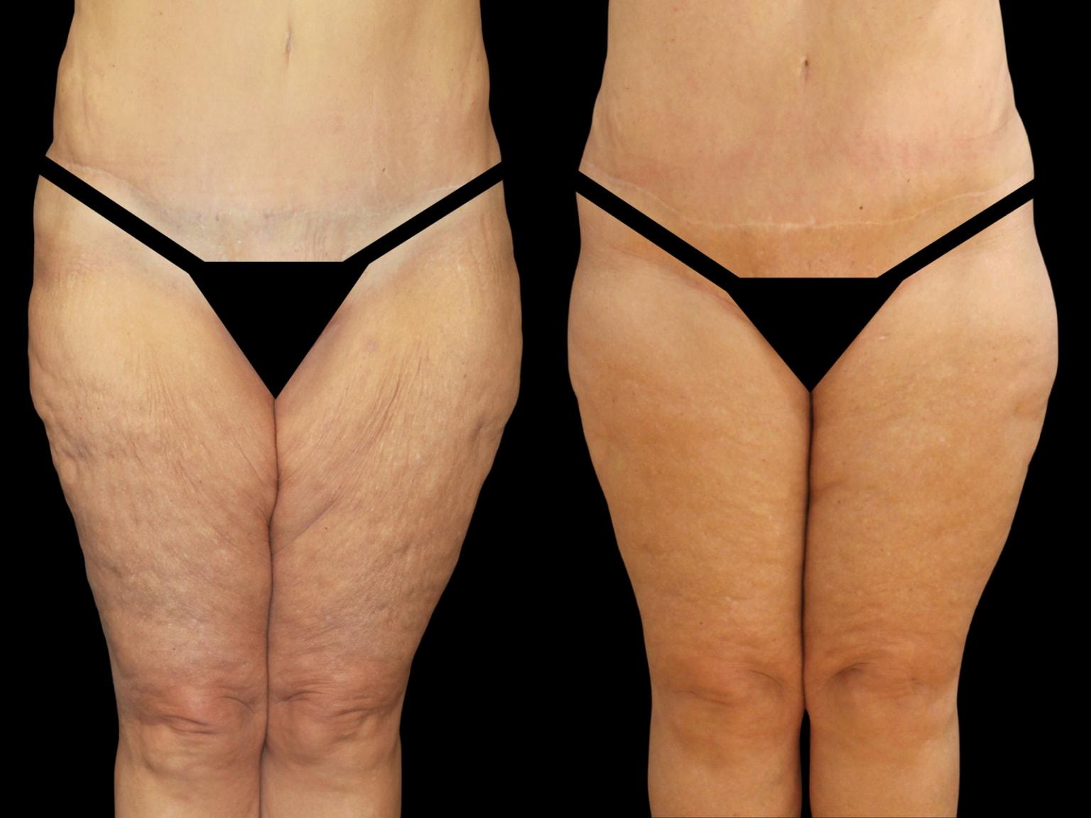 Soler-Baillo Plastic Surgery thigh lift result — Coral Gables, FL