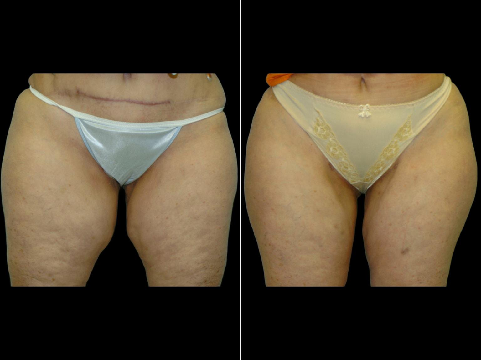 Soler-Baillo Plastic Surgery thigh lift result — Coral Gables, FL