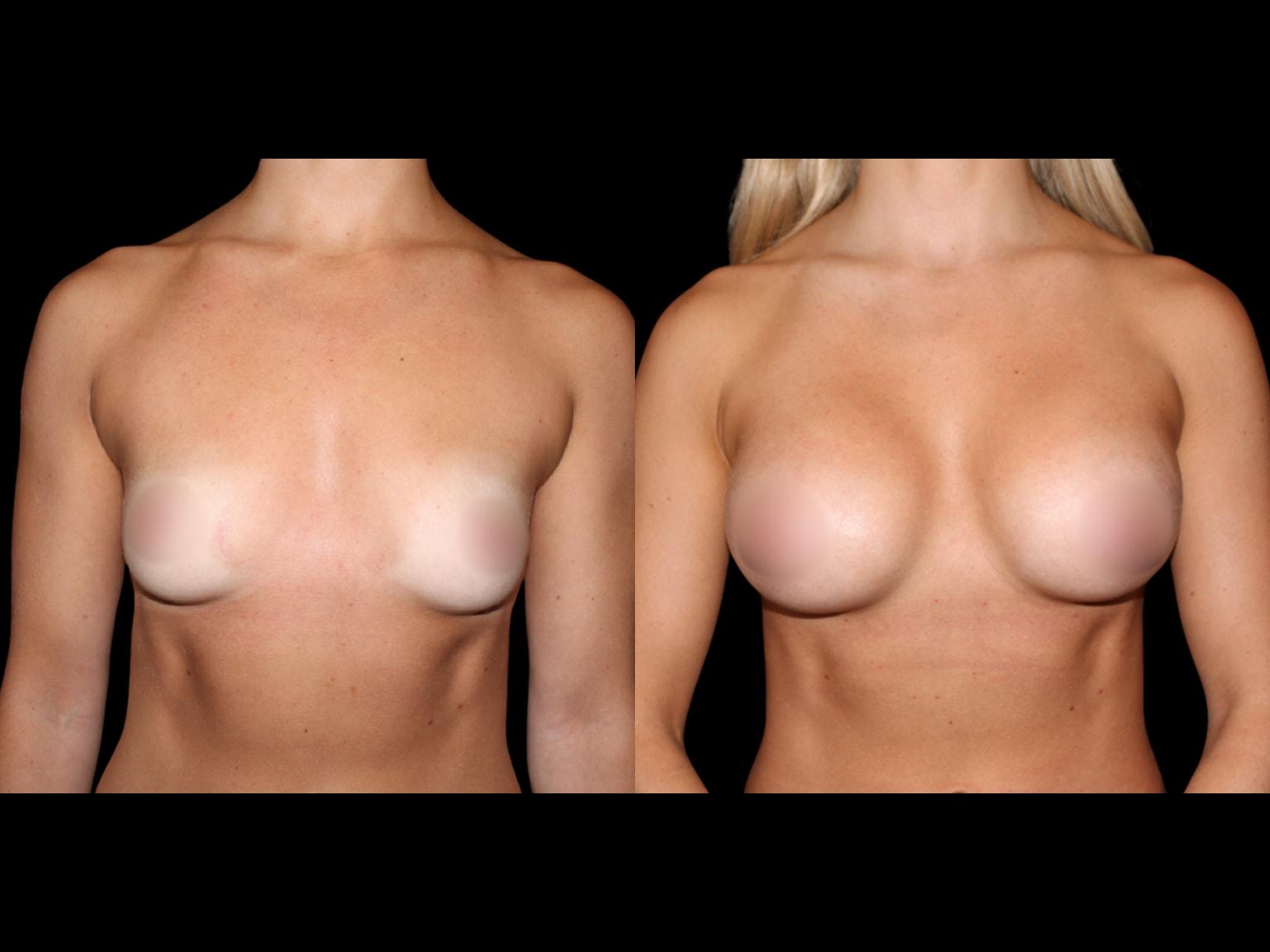 Soler-Baillo Plastic Surgery breast augmentation result — Coral Gables, FL