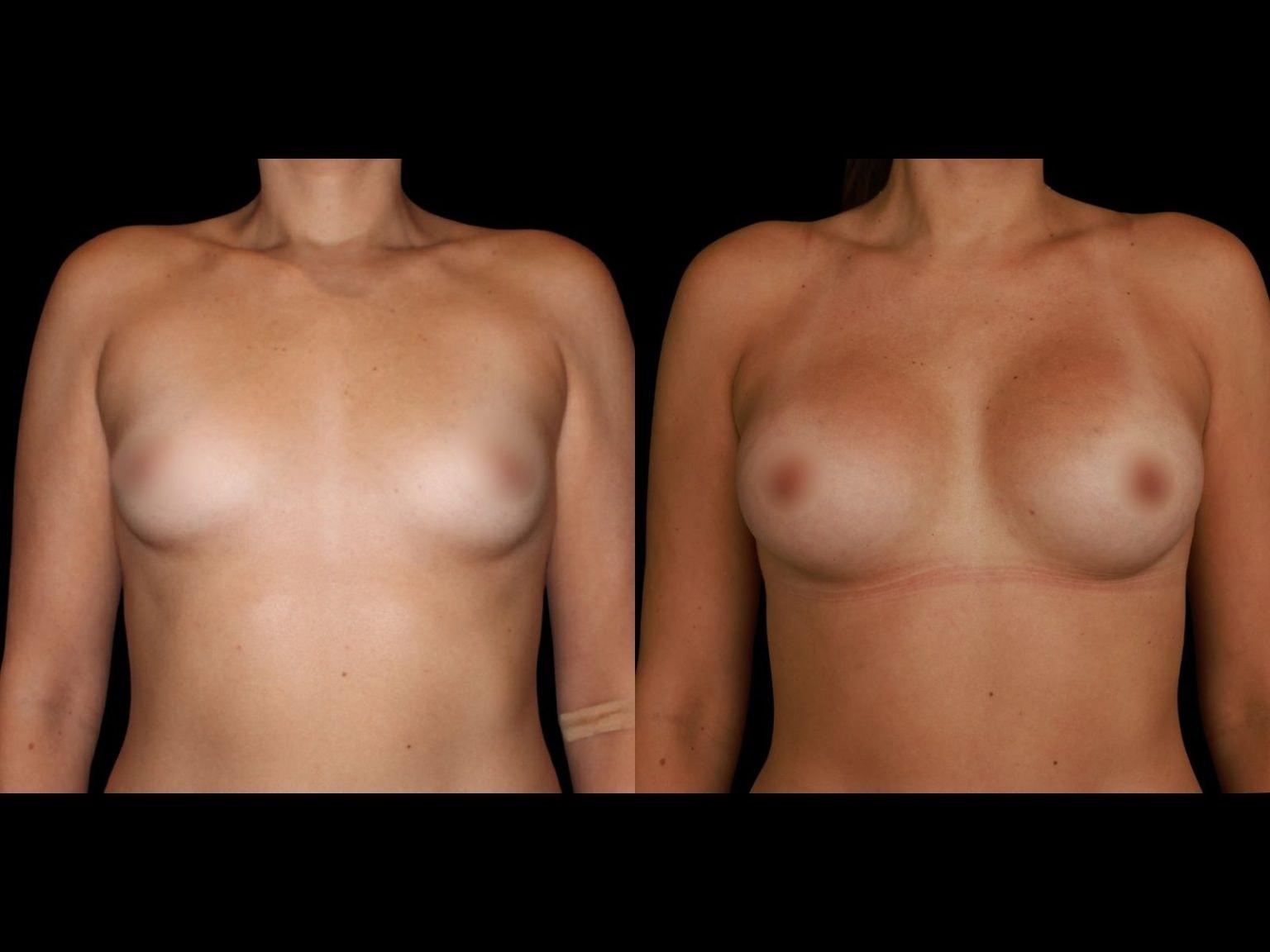 Soler-Baillo Plastic Surgery breast augmentation result — Coral Gables, FL