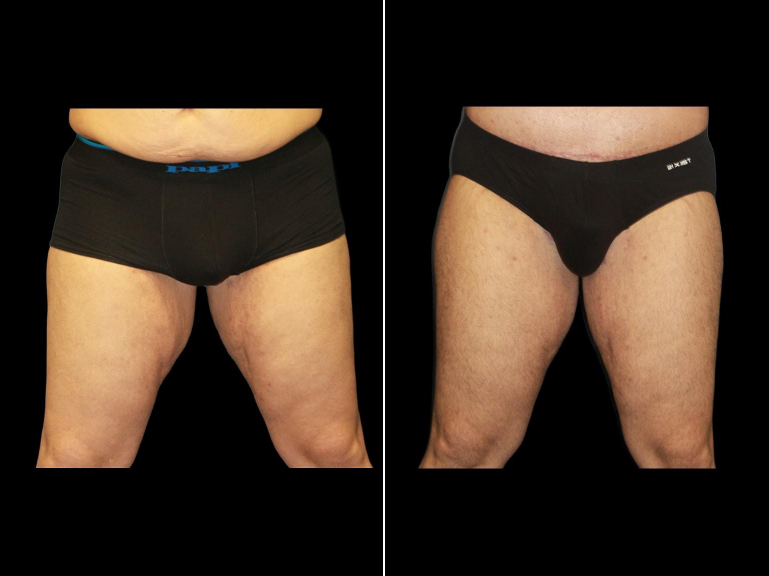 Soler-Baillo Plastic Surgery thigh lift result — Coral Gables, FL
