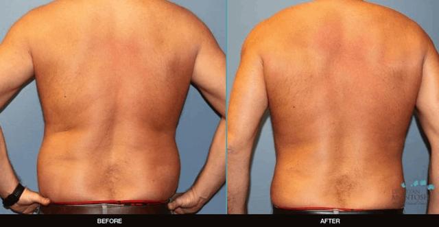 Liposuction result at Refine MD, Northwest in Bellevue, WA