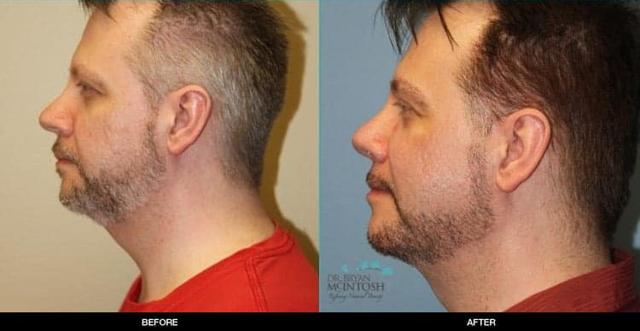 Rhinoplasty result at Refine MD, Northwest in Bellevue, WA