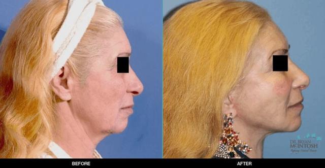 Brow Lift result at Refine MD, Northwest in Bellevue, WA