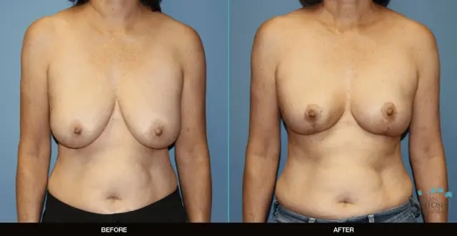Breast Reduction result at Refine MD, Northwest in Bellevue, WA