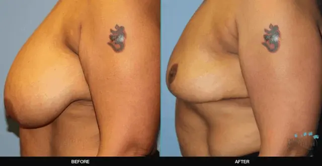 Breast Reduction result at Refine MD, Northwest in Bellevue, WA