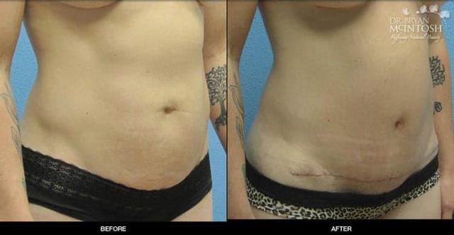 Mini Tummy Tuck result at Refine MD, Northwest in Bellevue, WA