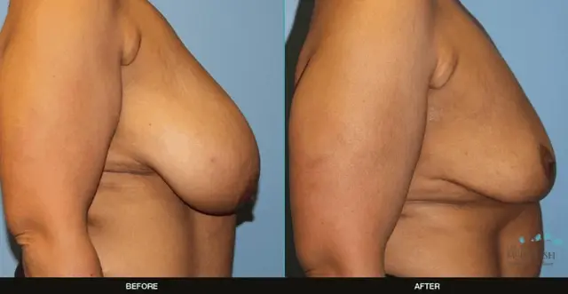 Breast Reduction result at Refine MD, Northwest in Bellevue, WA