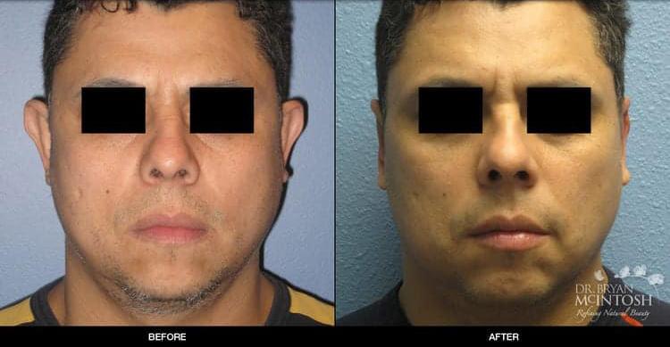 Refine MD, Northwest otoplasty result — Bellevue, WA
