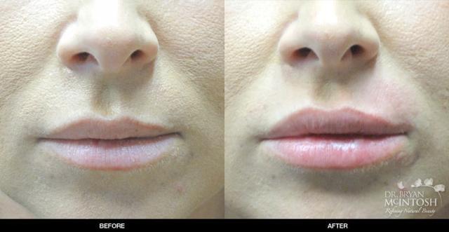 Lip Filler result at Refine MD, Northwest in Bellevue, WA