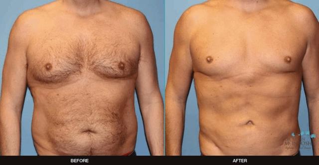 Gynecomastia Surgery result at Refine MD, Northwest in Bellevue, WA