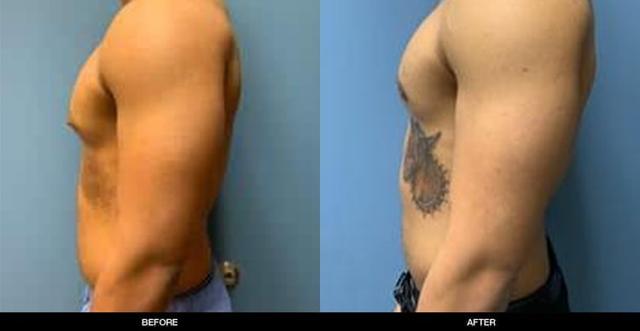 Gynecomastia Surgery result at Refine MD, Northwest in Bellevue, WA