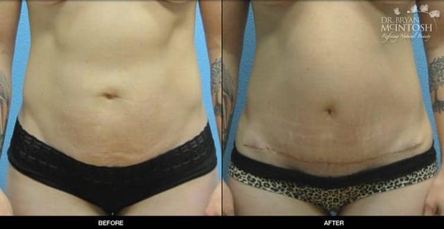 Mini Tummy Tuck result at Refine MD, Northwest in Bellevue, WA