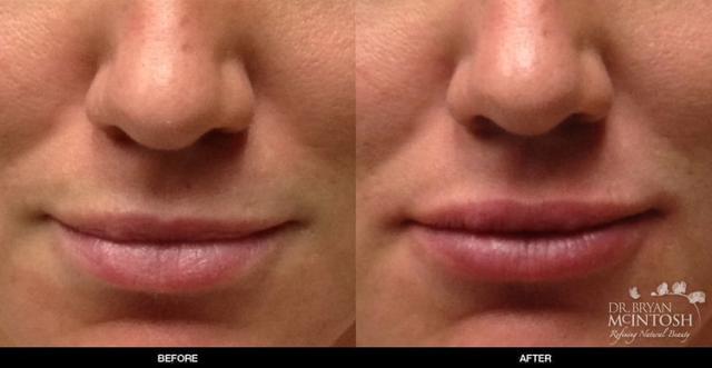 Lip Filler result at Refine MD, Northwest in Bellevue, WA