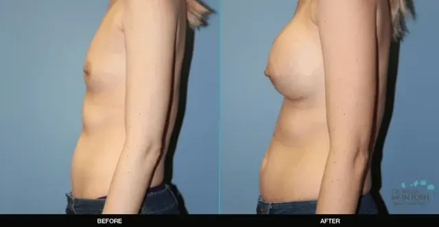 Breast Augmentation result at Refine MD, Northwest in Bellevue, WA