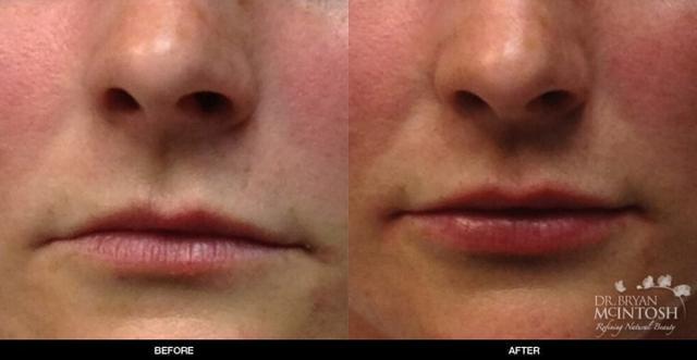Lip Filler result at Refine MD, Northwest in Bellevue, WA
