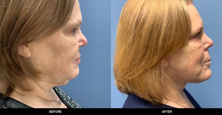 Refine MD, Northwest neck lift result — Bellevue, WA