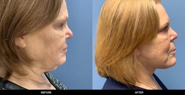 Neck Lift result at Refine MD, Northwest in Bellevue, WA
