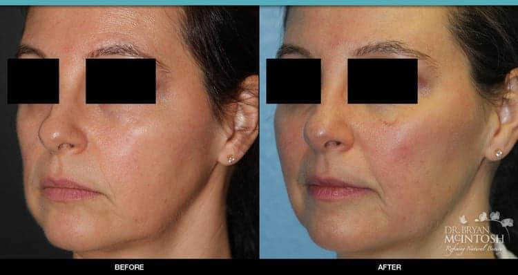 Refine MD, Northwest cheek filler result — Bellevue, WA