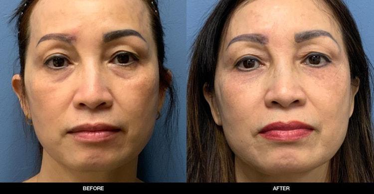 Refine MD, Northwest eyelid lift result — Bellevue, WA
