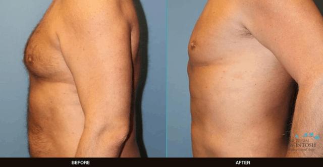 Gynecomastia Surgery result at Refine MD, Northwest in Bellevue, WA