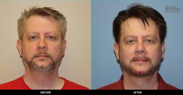 Rhinoplasty result at Refine MD, Northwest in Bellevue, WA