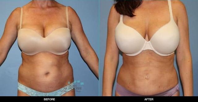 Liposuction result at Refine MD, Northwest in Bellevue, WA